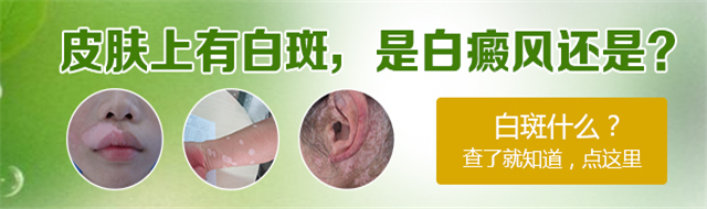 白癜风常识